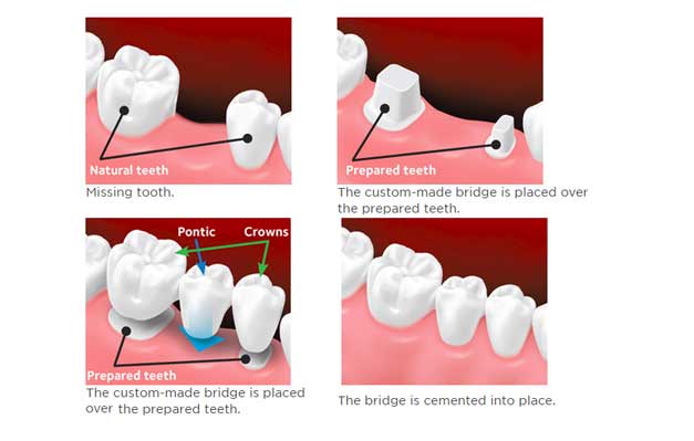 Dental Bridge - Computer AMC Services in Delhi NCR